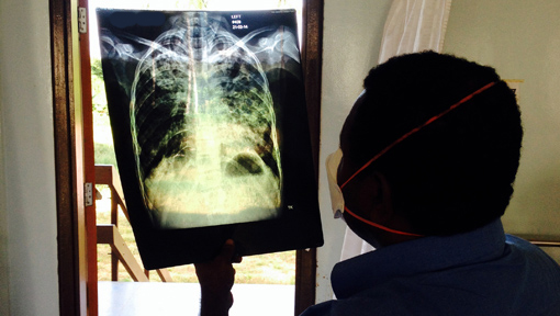 RID-TB: Reducing the Impact of Drug-Resistant TB in Western Province, Papua New Guinea